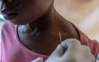 A boy receives treatment for mpox at the Munigi Health Centre in Munigi, Democratic Republic of the Congo